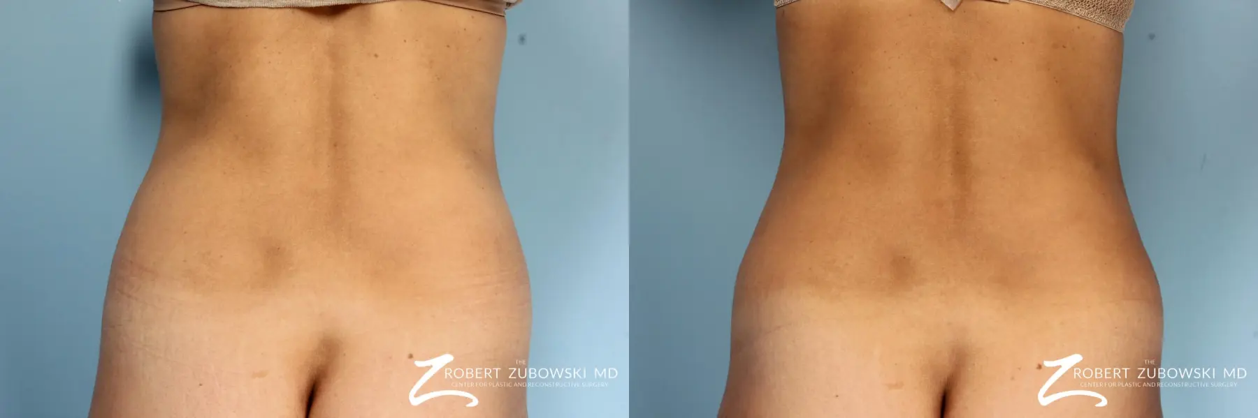 CoolSculpting®: Patient 4 - Before and After 2