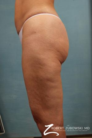 Cellulaze: Patient 2 - Before and After Image 2