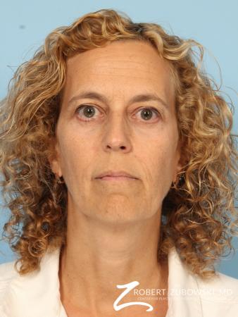 Blepharoplasty: Patient 29 - After Image 1