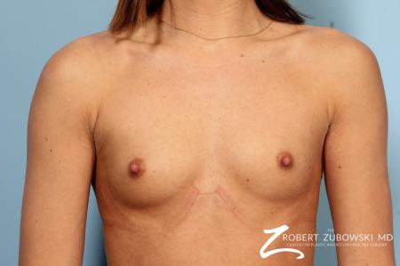 Breast Augmentation: Patient 37 - Before Image 1