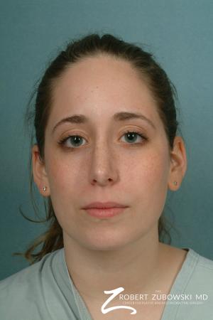 Rhinoplasty: Patient 7 - After Image 1