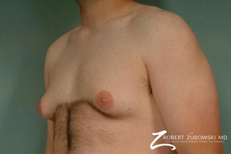 Gynecomastia: Patient 1 - Before and After Image 2