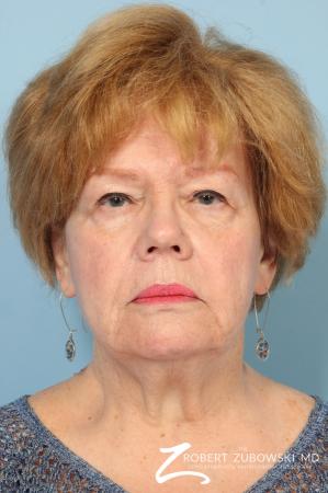 Facelift: Patient 26 - Before Image 1