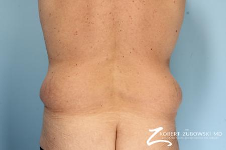 Body Lift: Patient 8 - Before Image 2