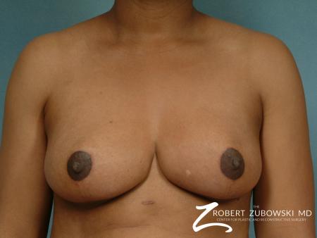 Breast Reduction: Patient 2 - After Image 1