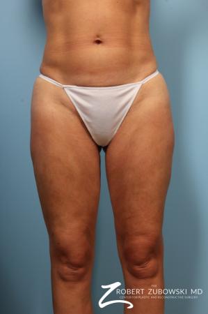 Cellulaze: Patient 2 - After Image 1