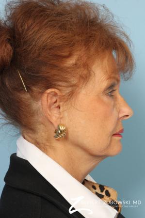 Facelift: Patient 24 - Before and After Image 2