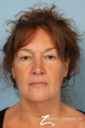 Chemical Peel: Patient 1 - Before Image 1