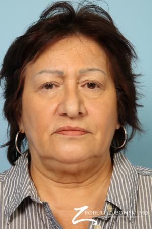 Blepharoplasty: Patient 31 - Before Image 1
