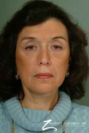 Brow Lift: Patient 6 - After Image 1