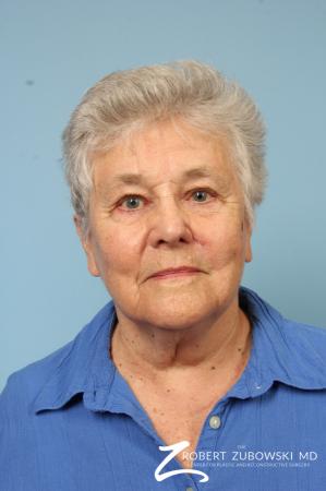 Mohs Closure: Patient 3 - After Image 1