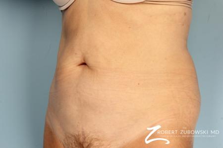 CoolSculpting®: Patient 4 - Before and After Image 3