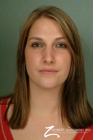 Rhinoplasty: Patient 2 - After Image 1