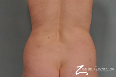 Liposuction: Patient 22 - After Image 1