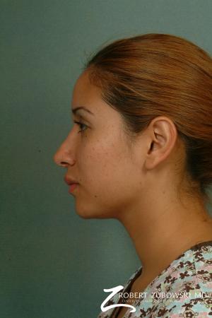 Rhinoplasty: Patient 13 - After Image 2