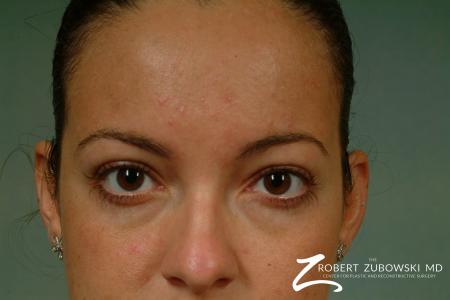 Latisse: Patient 1 - After Image 2