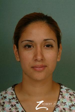 Rhinoplasty: Patient 13 - After Image 1