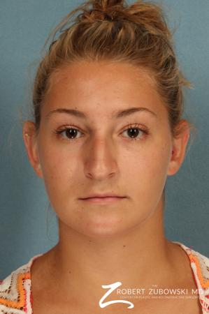 Rhinoplasty: Patient 18 - Before Image 1