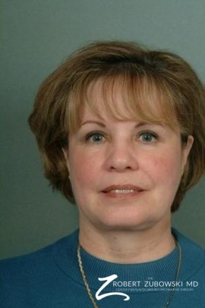 Blepharoplasty: Patient 9 - After Image 1