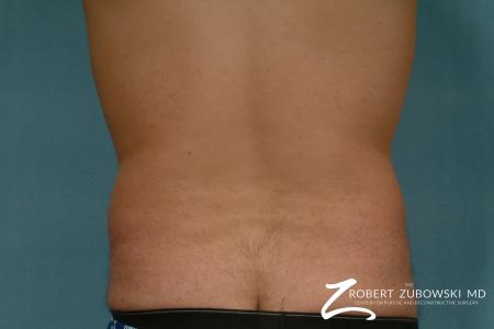Liposuction: Patient 30 - Before and After Image 2