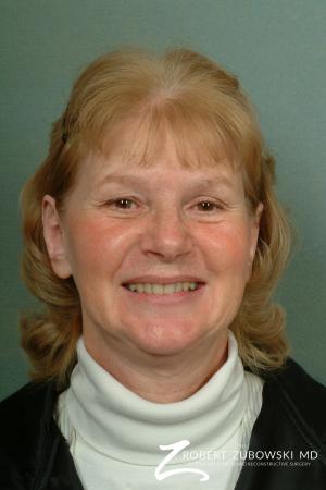 Otoplasty: Patient 2 - After Image 1
