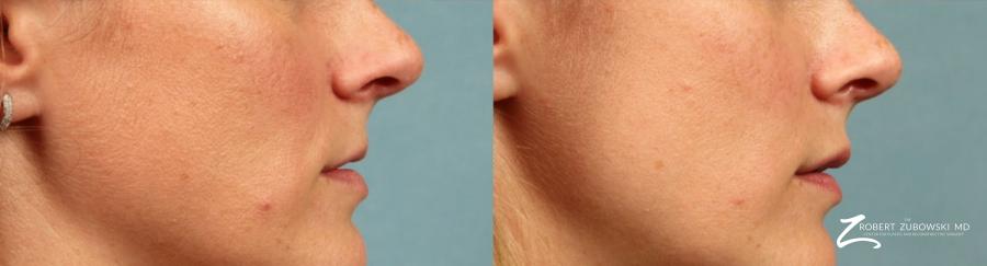 Permanent Lip Enhancement: Patient 1 - Before and After Image 2