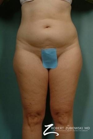 Liposuction: Patient 6 - Before Image 1