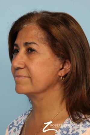 Brow Lift: Patient 8 - After Image 2