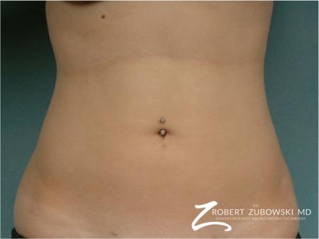 Liposuction: Patient 39 - After Image 1