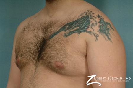 Gynecomastia: Patient 9 - After Image 2