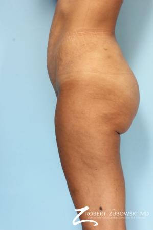 Liposuction: Patient 49 - After Image 3