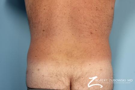 Liposuction: Patient 10 - After Image 1