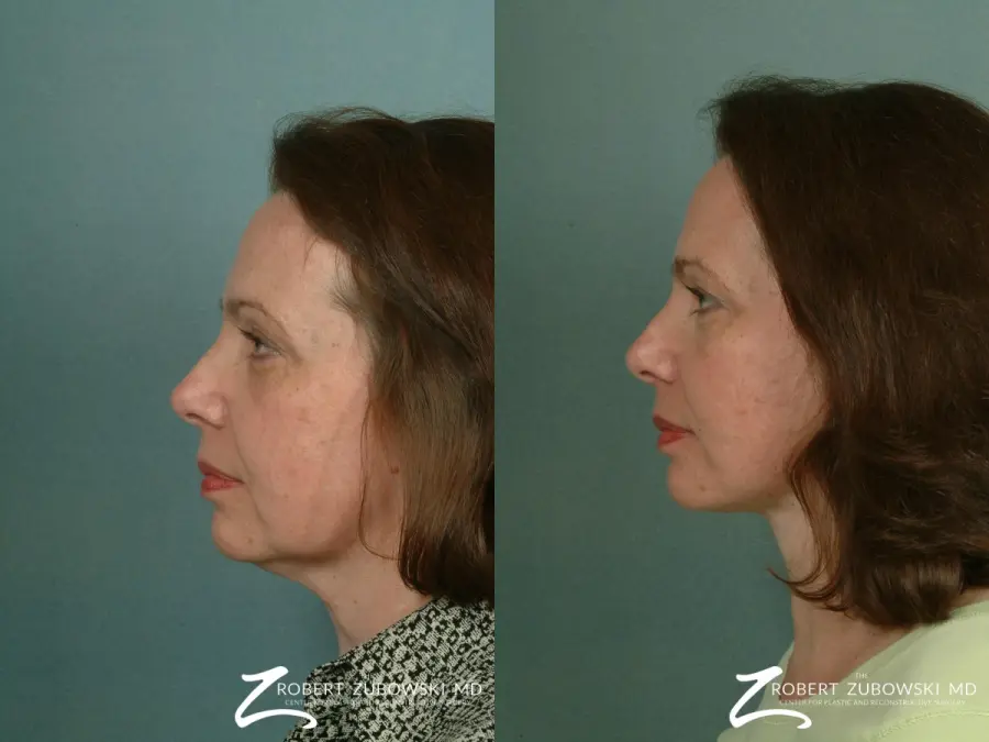Facelift: Patient 21 - Before and After 2