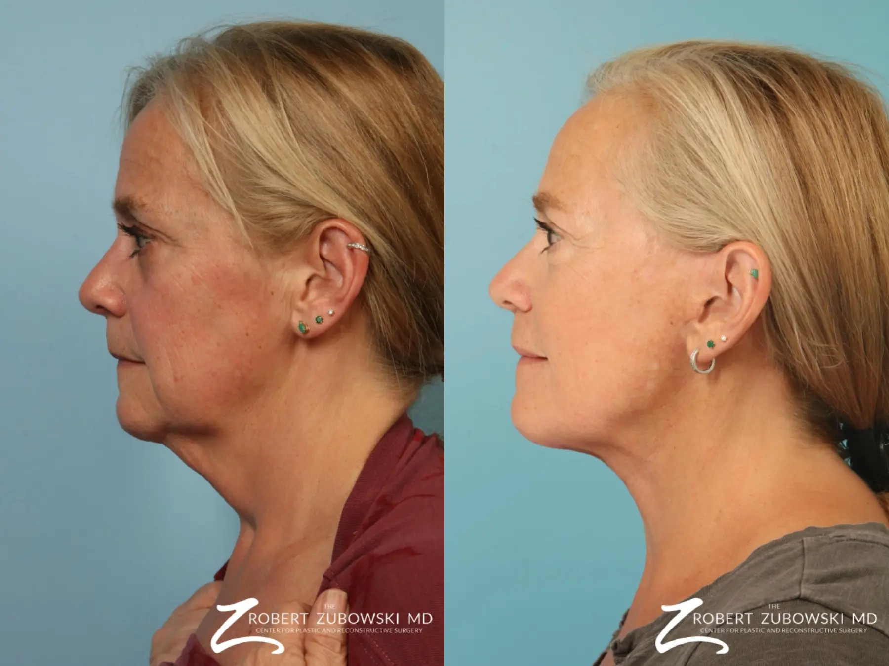 Facelift: Patient 30 - Before and After 2