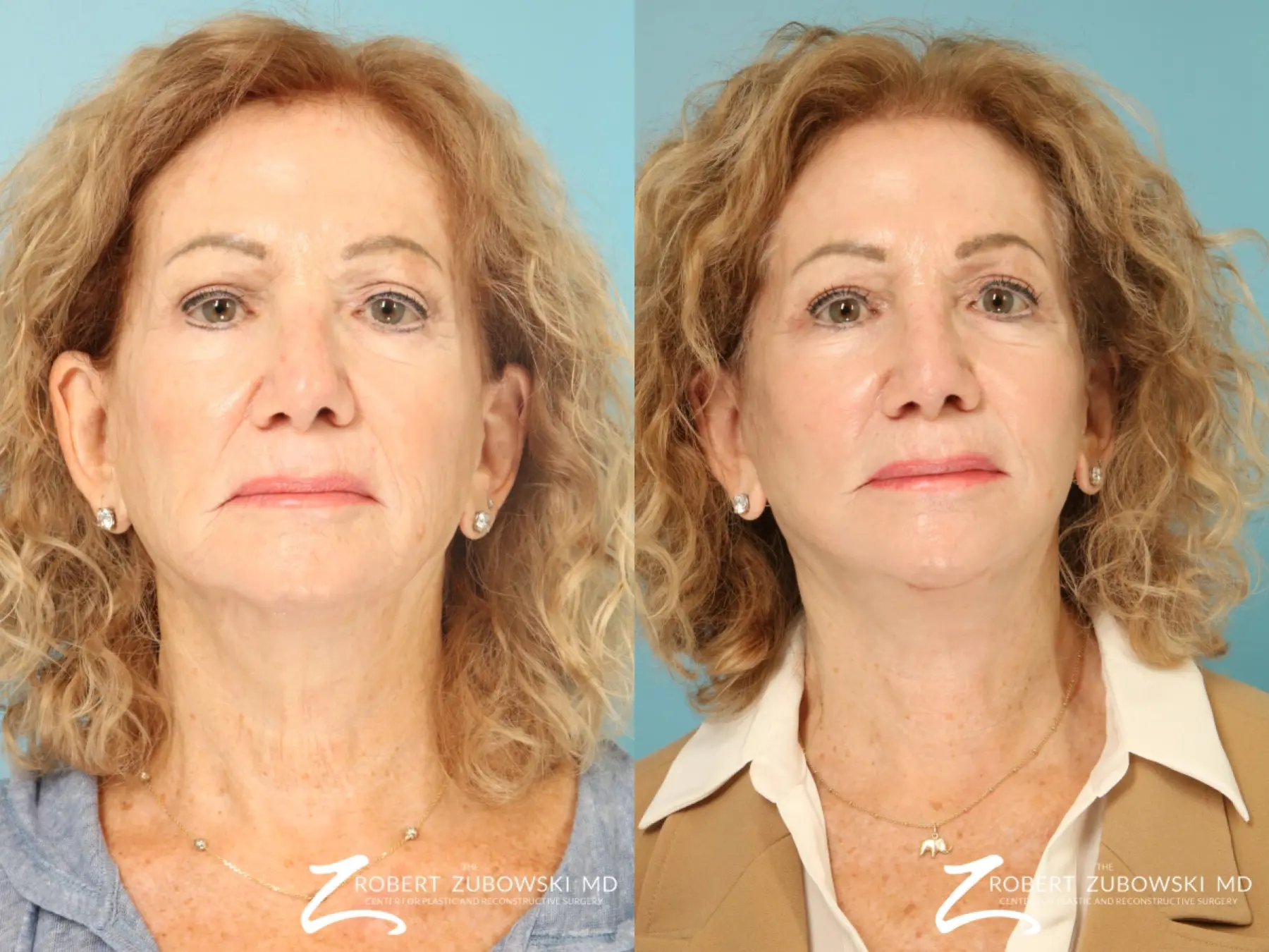 Facelift: Patient 31 - Before and After  