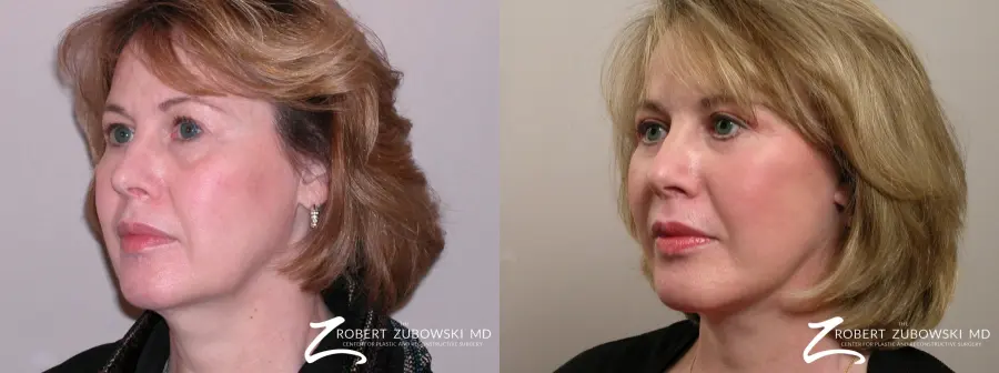 Facelift: Patient 29 - Before and After 2