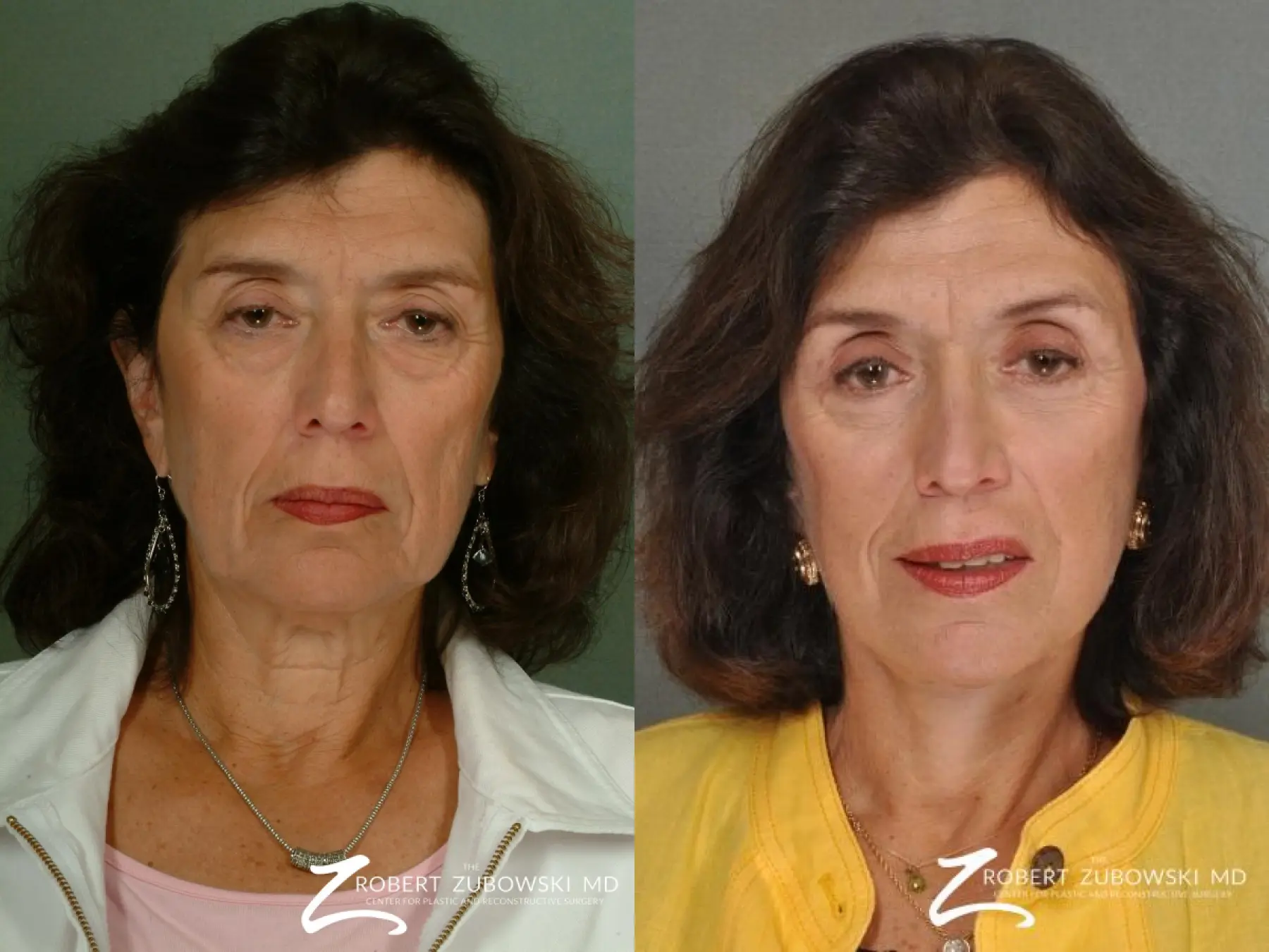Facelift: Patient 13 - Before and After  