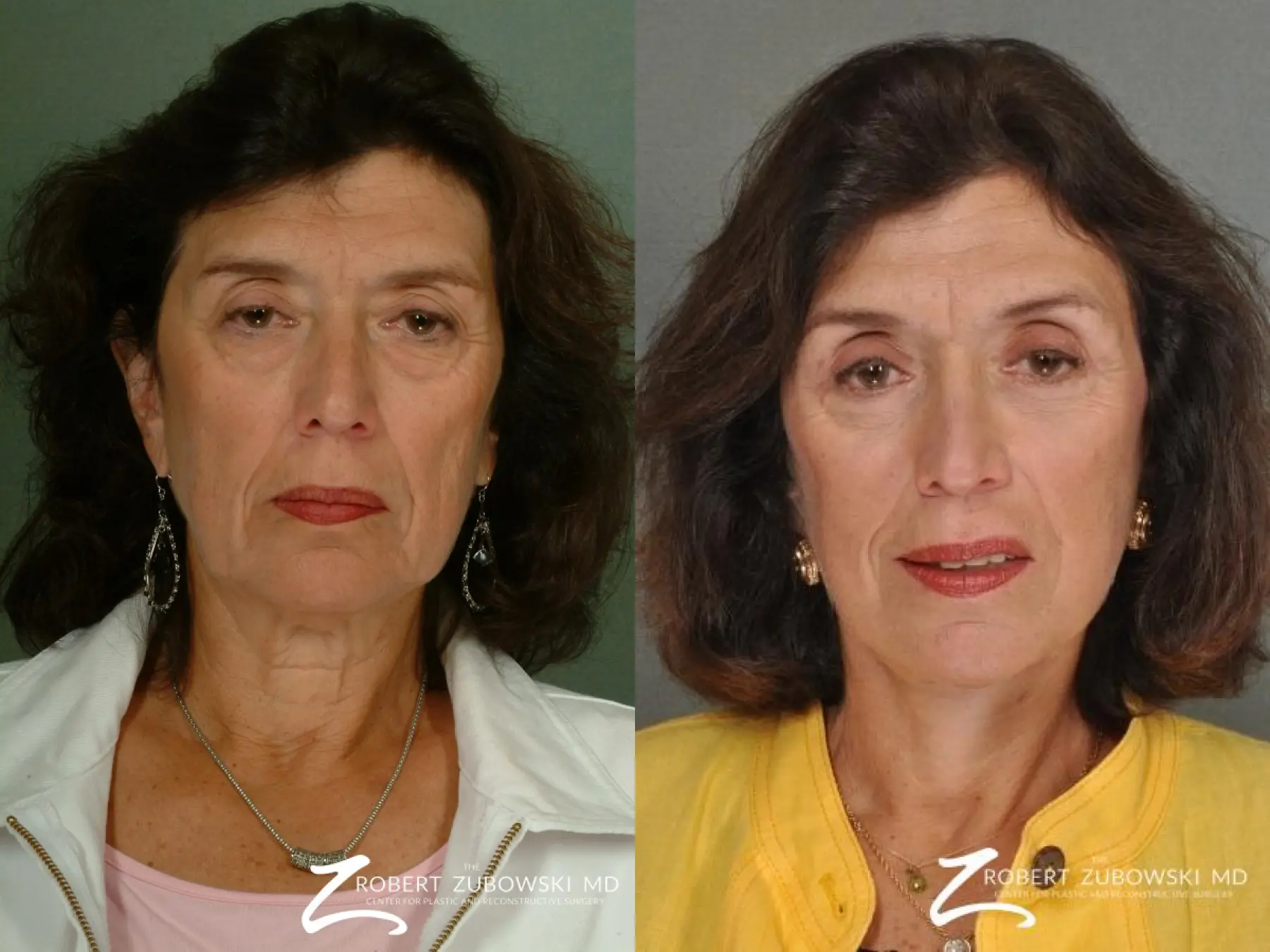 Facelift Before & After Gallery: Patient 13