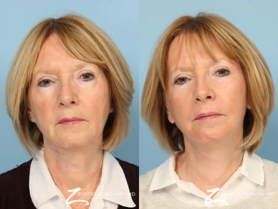 Facelift: Patient 19 - Before and After  