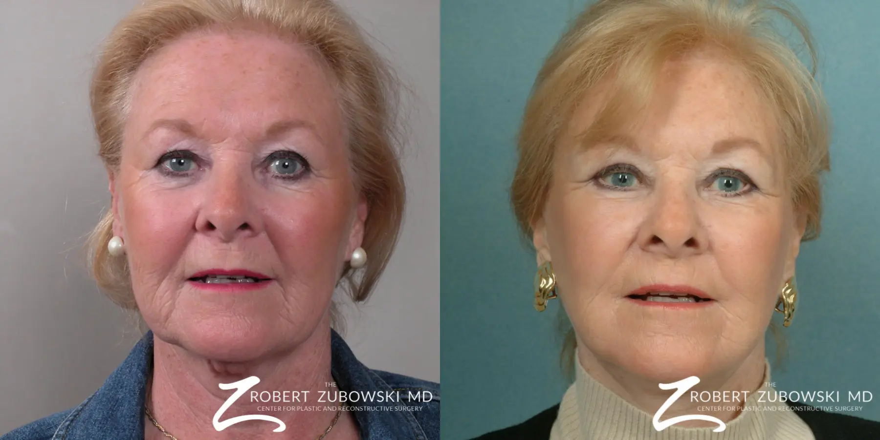 Facelift: Patient 27 - Before and After  