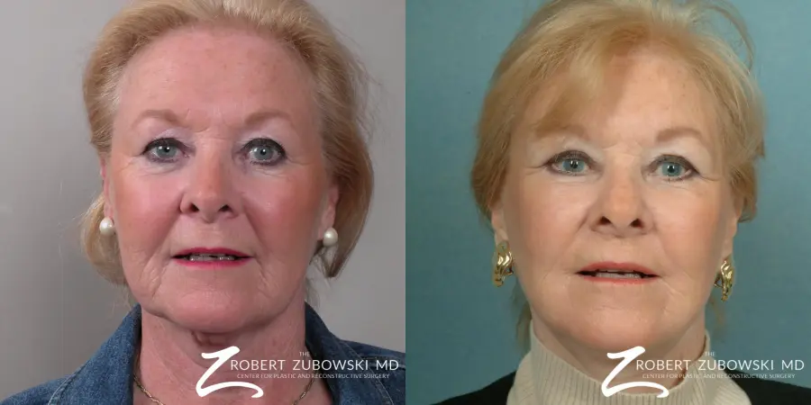 Facelift: Patient 15 - Before and After  