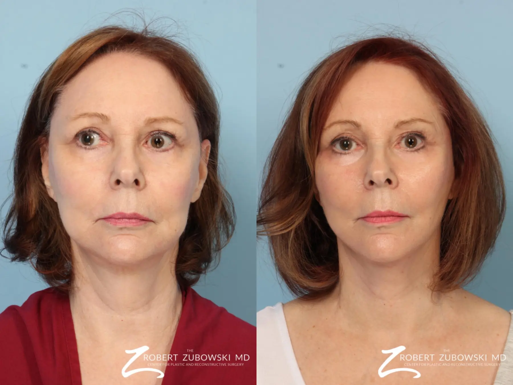 Facelift: Patient 4 - Before and After  