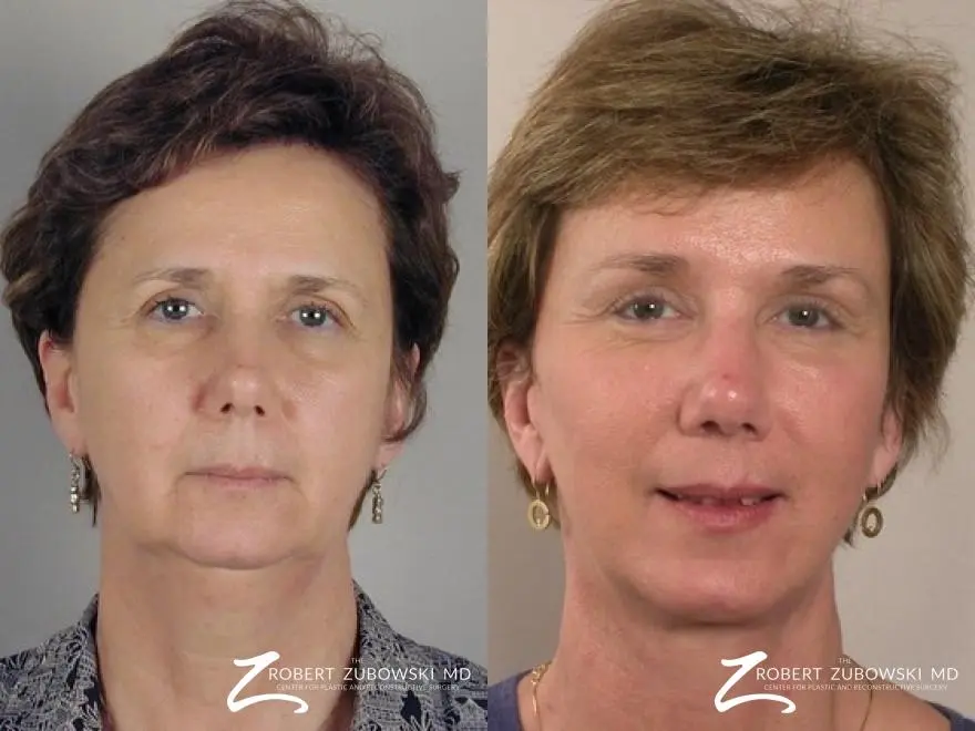 Facelift: Patient 19 - Before and After  