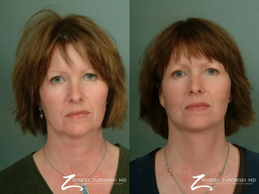 Facelift: Patient 4 - Before and After  