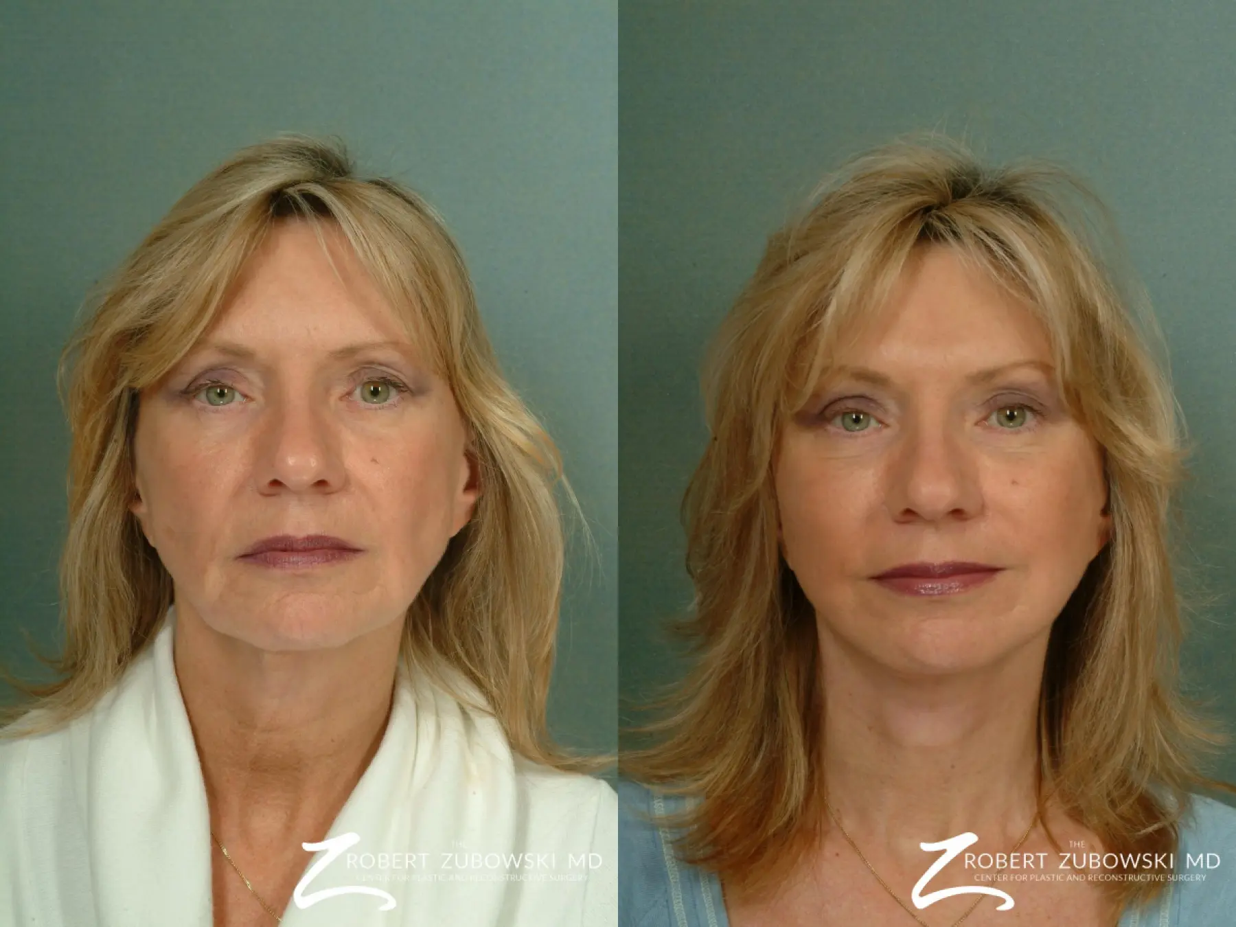 Facelift: Patient 2 - Before and After  