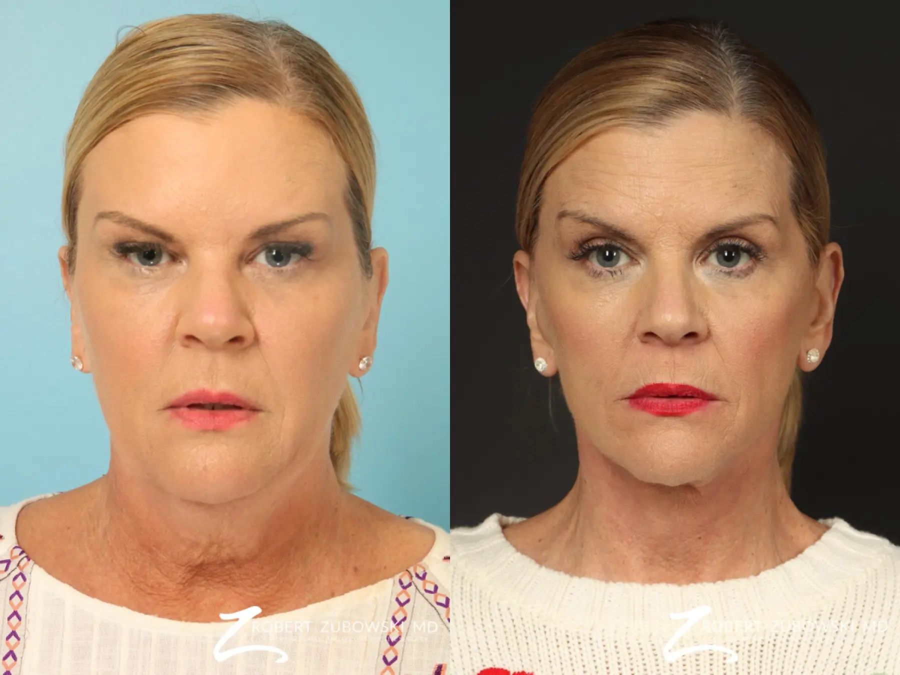 Facelift: Patient 33 - Before and After 1