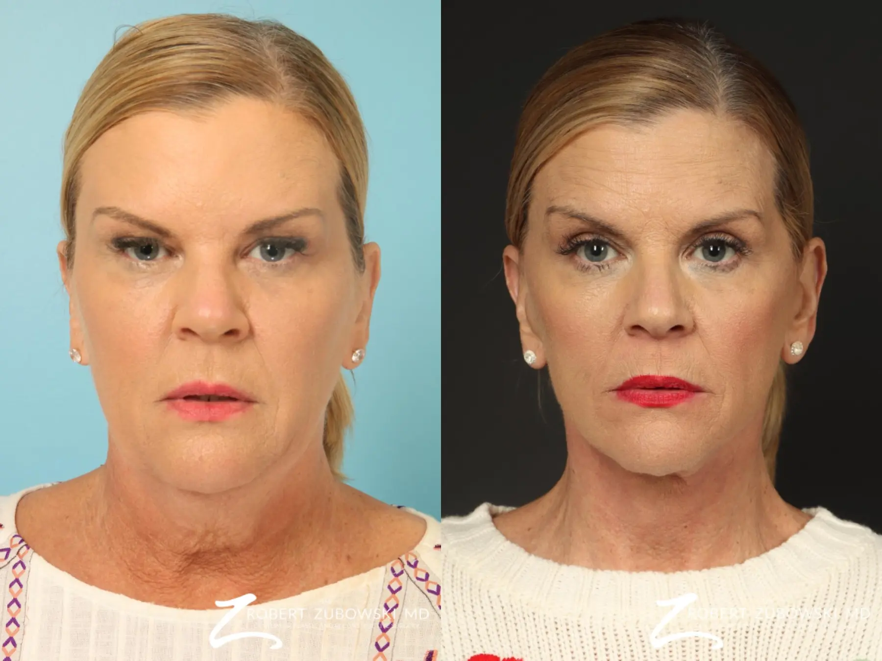 Facelift: Patient 33 - Before and After  