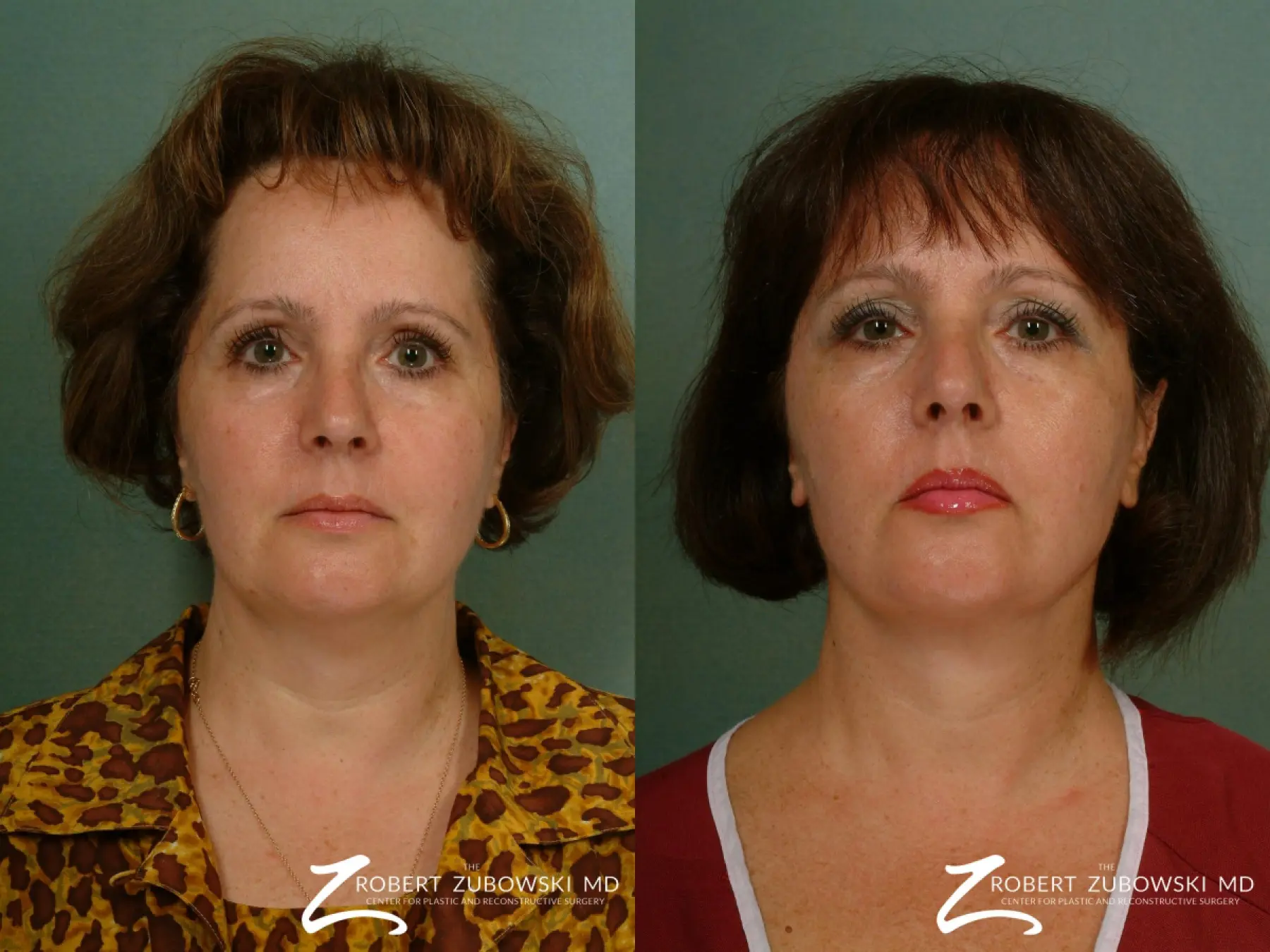 Facelift: Patient 14 - Before and After  