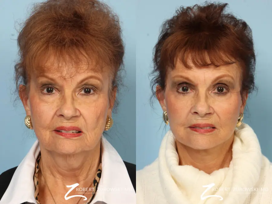 Facelift: Patient 26 - Before and After  