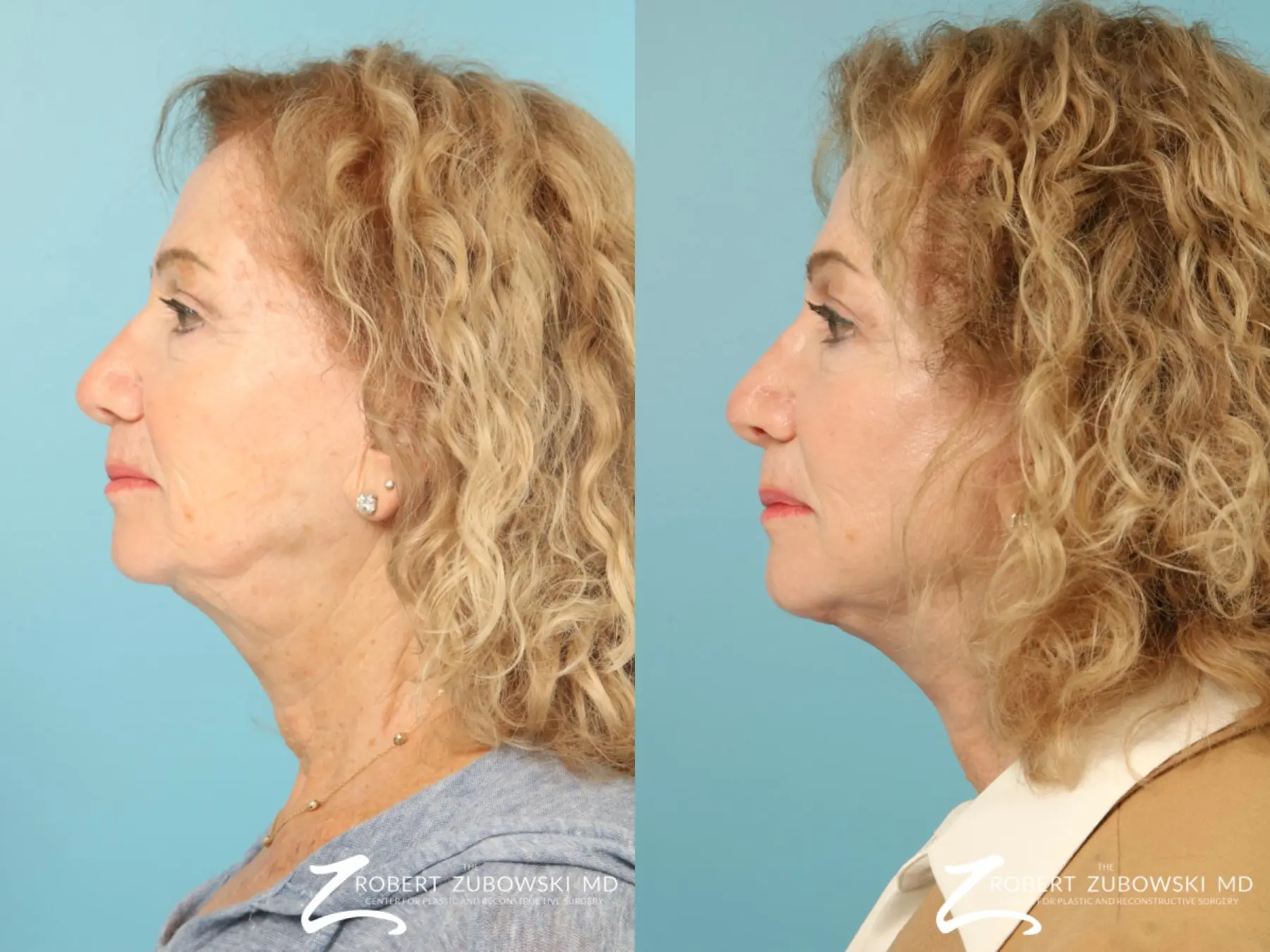 Facelift: Patient 31 - Before and After 2